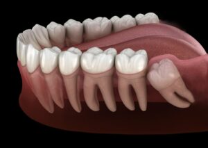 diagram of wisdom tooth growing in