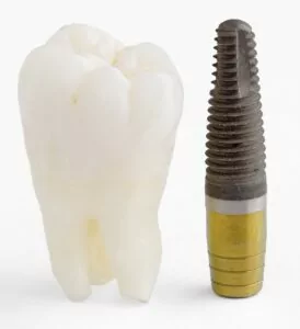 dental implant marble falls
