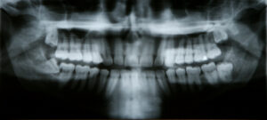 impacted wisdom teeth