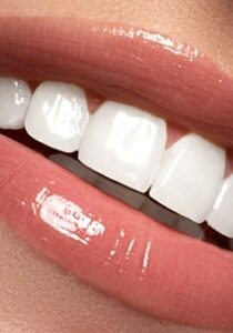 teeth whitening 