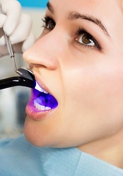 Dentist uses ultraviolet curing light to harden Dental Bonding resin