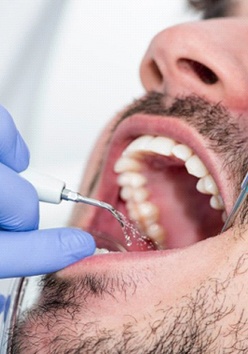 man getting dental cleaning