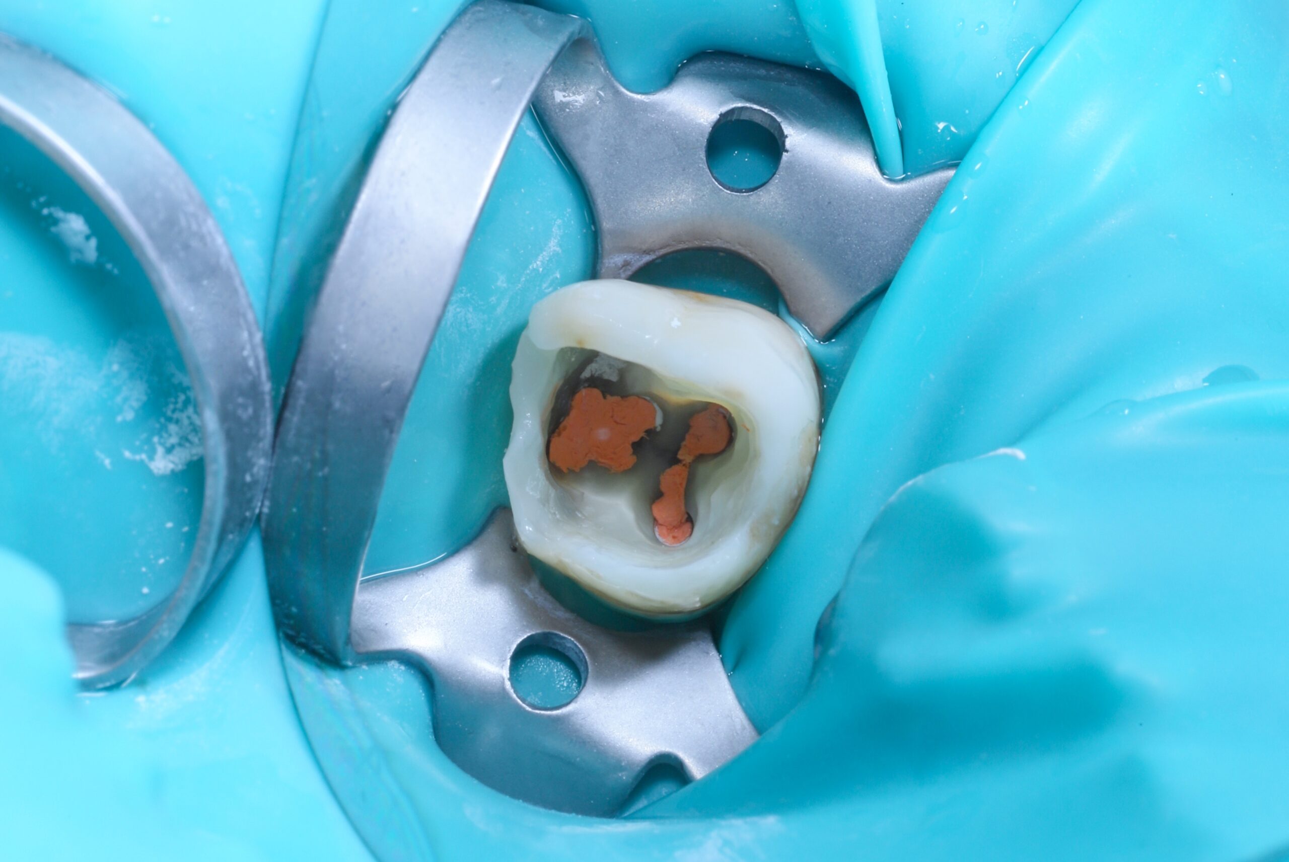 h. Dental root canal treatment. Tooth pulp