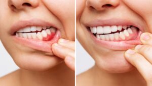 Two shots of a young woman with red bleeding gums and health gums, before and after treatment on a white background