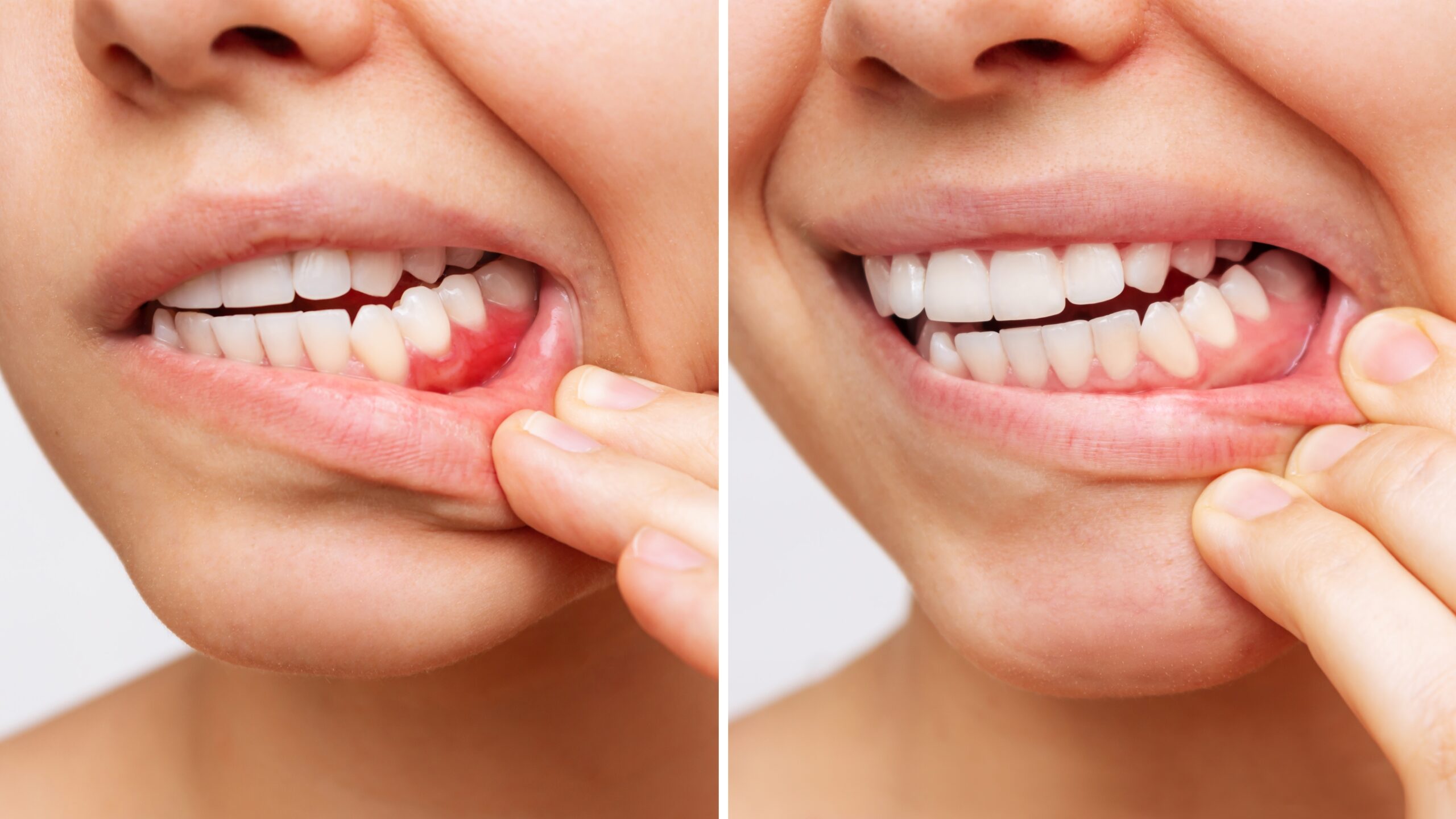 Two shots of a young woman with red bleeding gums and health gums, before and after treatment on a white background