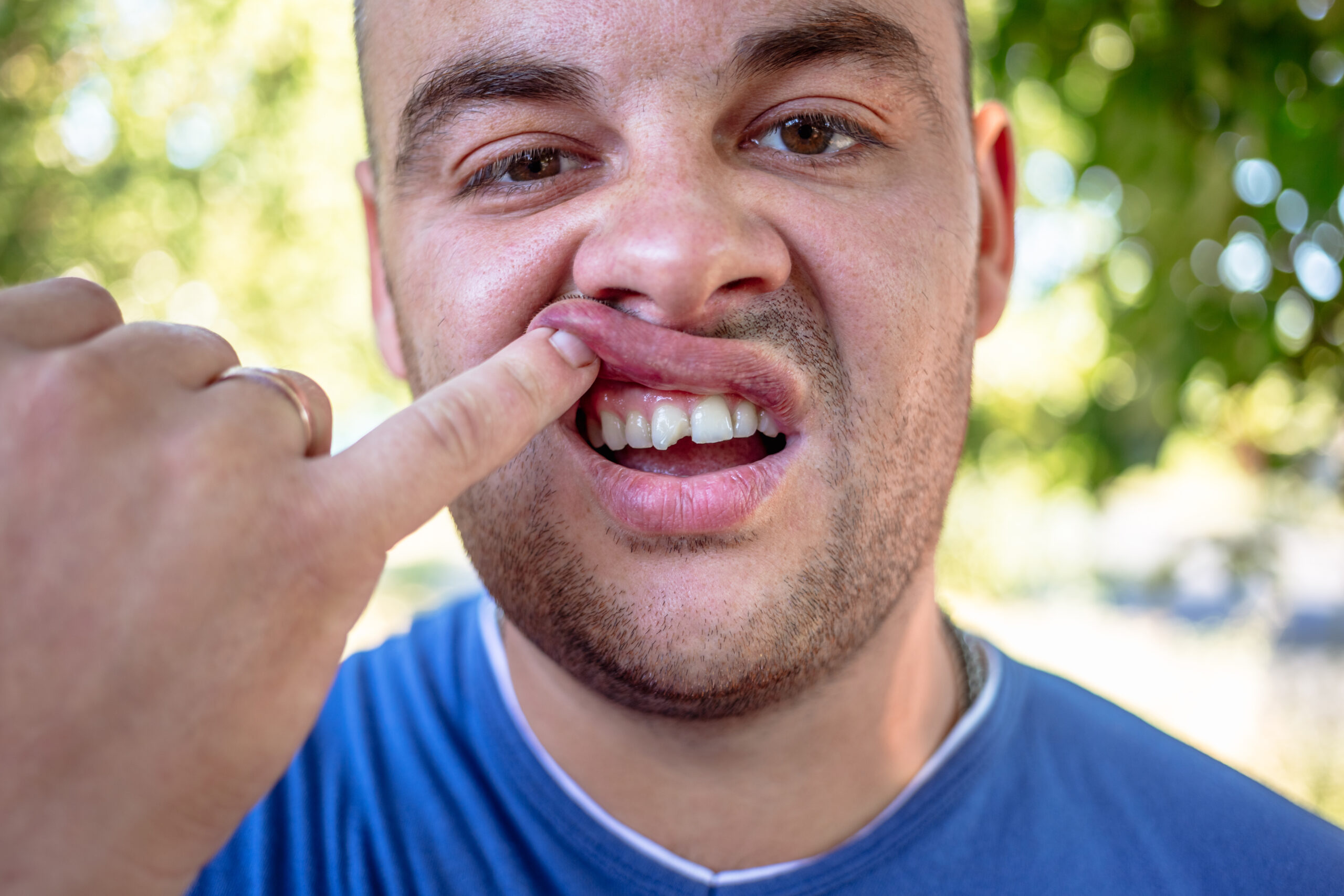 young man in blue shirt exposing his chipped tooth