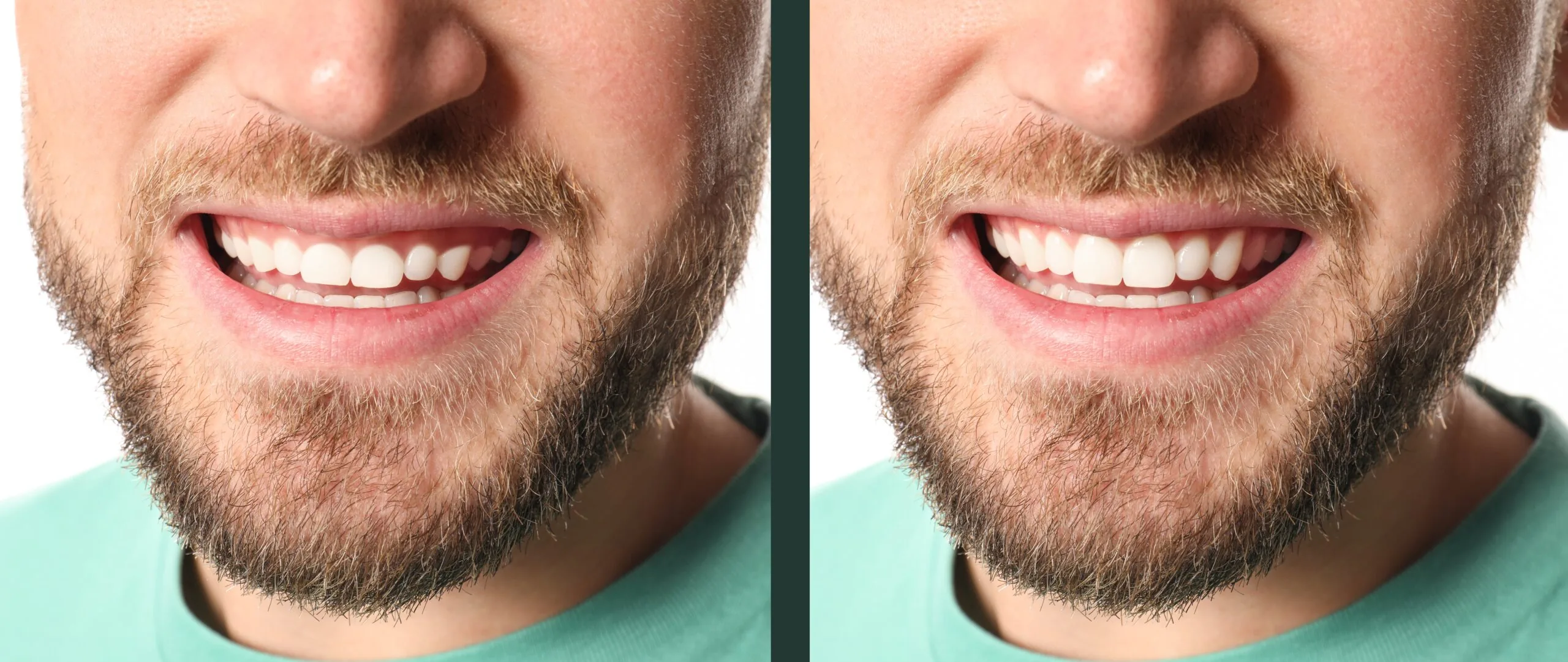 before and after of a laser dental treatment