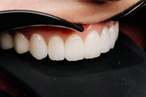 closeup of a dental veneer application against a black background